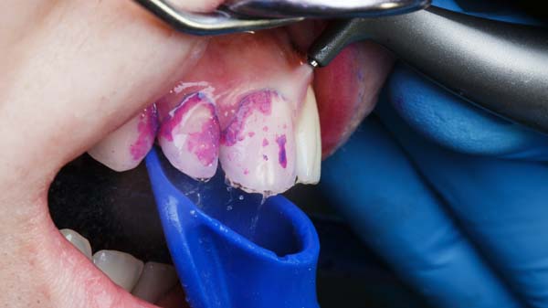 How Often A Dentist Recommends A Dental Cleaning