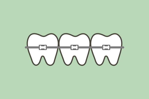 Ways To Straighten Your Smile Without Braces