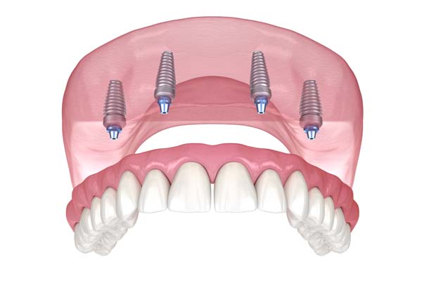 How Common Are Implant Supported Dentures?